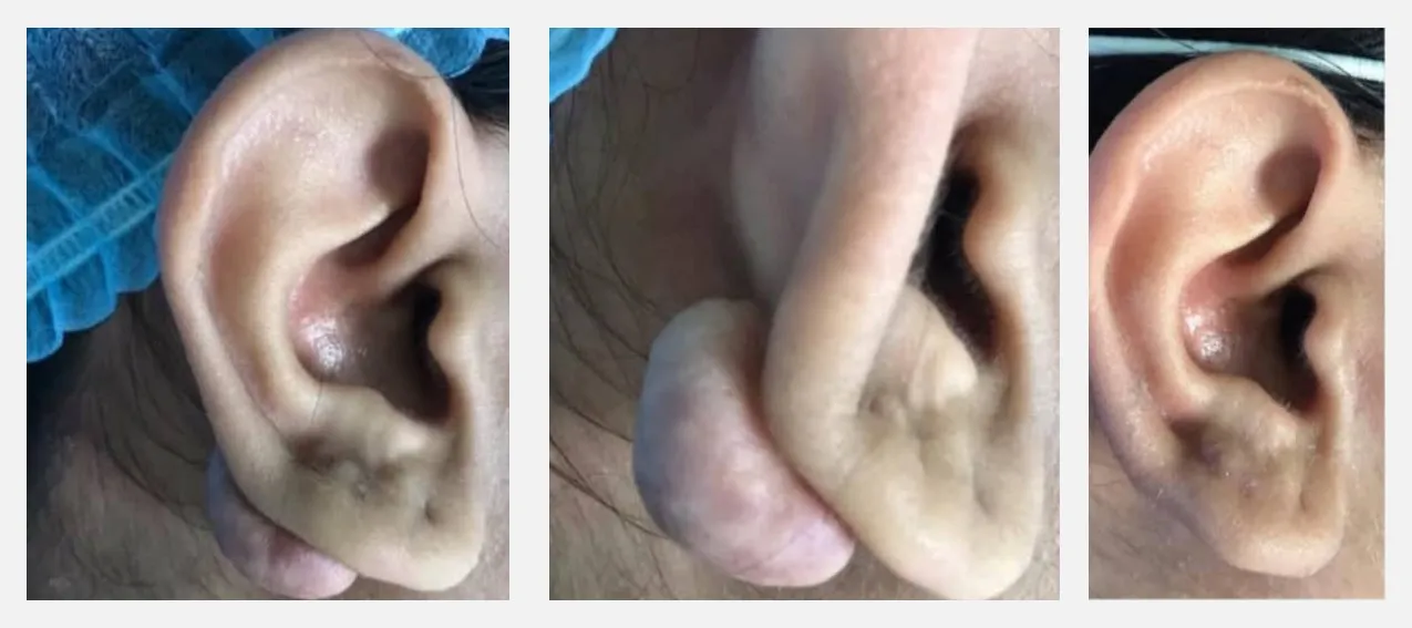 Cicatrices chéloïdes : comprendre et bien les prendre en charge